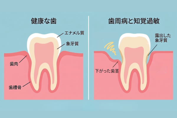 知覚過敏のしくみ